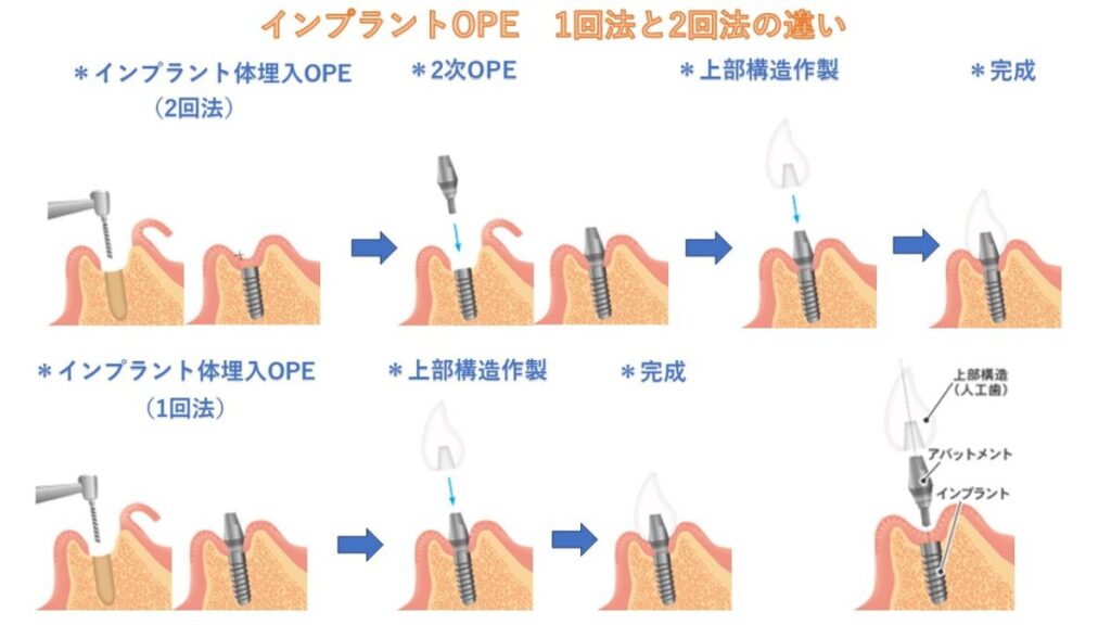 インプラント手術の流れ　大阪市城東区　しぎの歯科