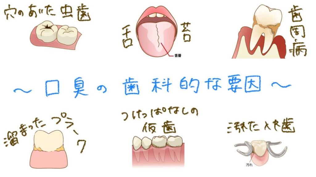 口臭の歯科的な要因