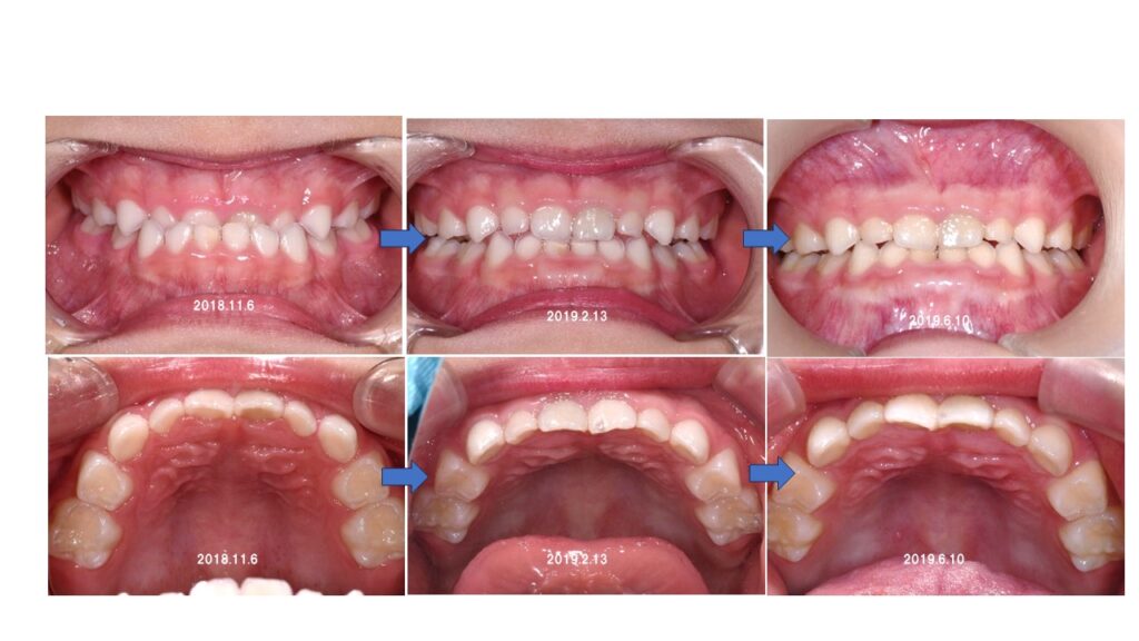 実際の患者様の歯並びの変化　（受け口・歯並び治療）