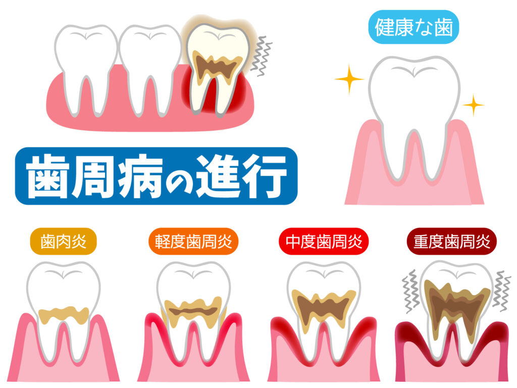 歯周病の進行イメージ