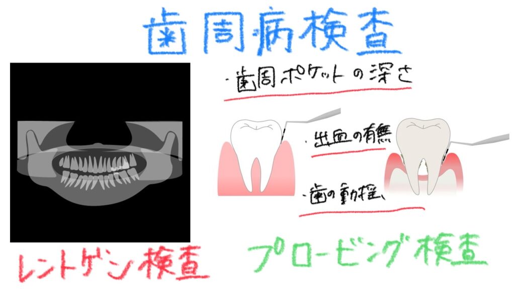 歯周病検査のイメージ