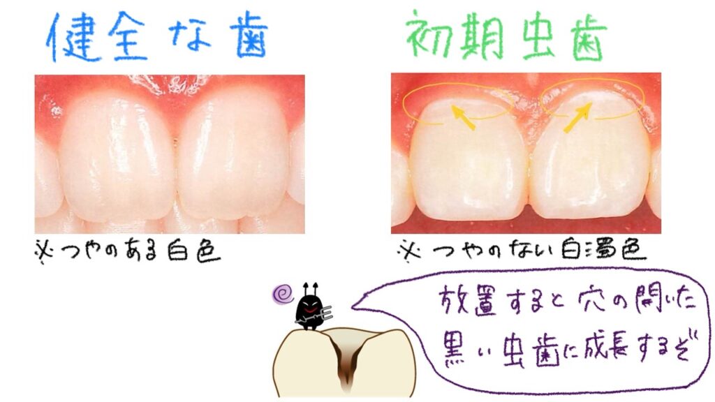 健全な歯と初期虫歯の違い