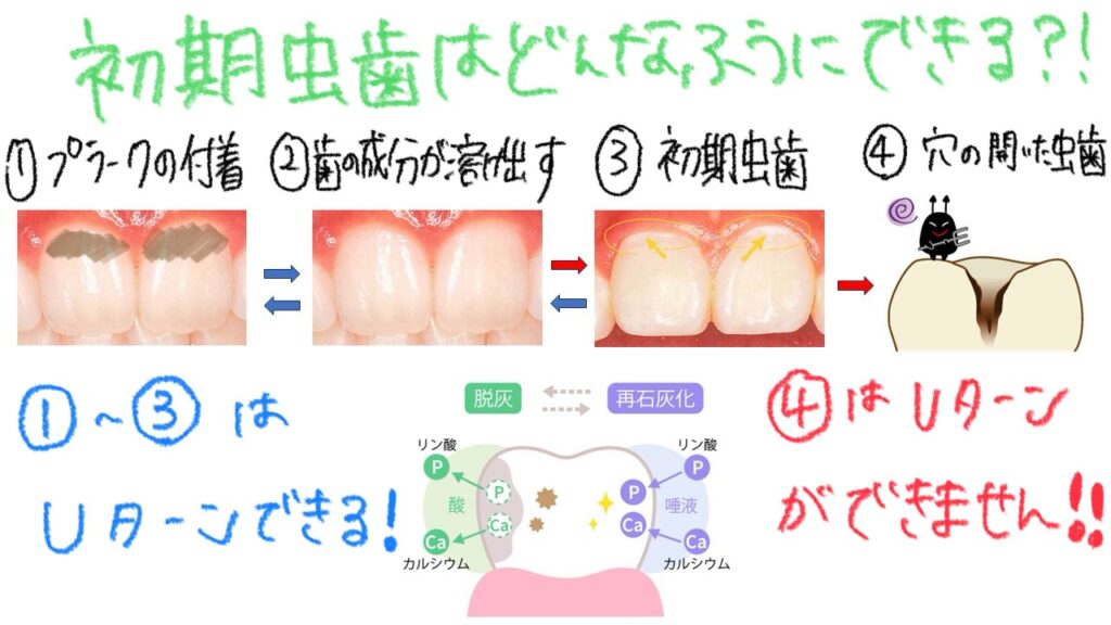 初期虫歯はどんなふうにできる