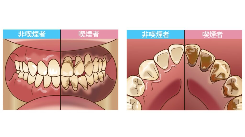 喫煙者と非喫煙者は歯茎にも違いがでる図