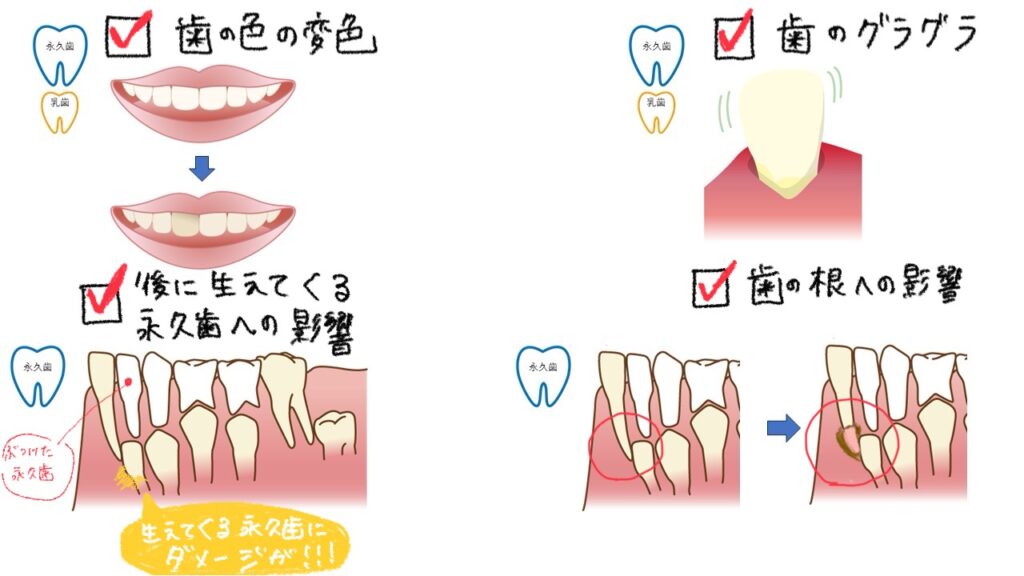 歯の根への影響