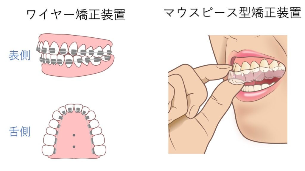 ワイヤー矯正装置とマウスピース矯正装置