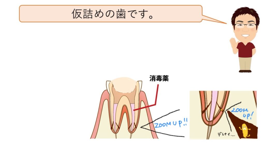 仮詰めの歯