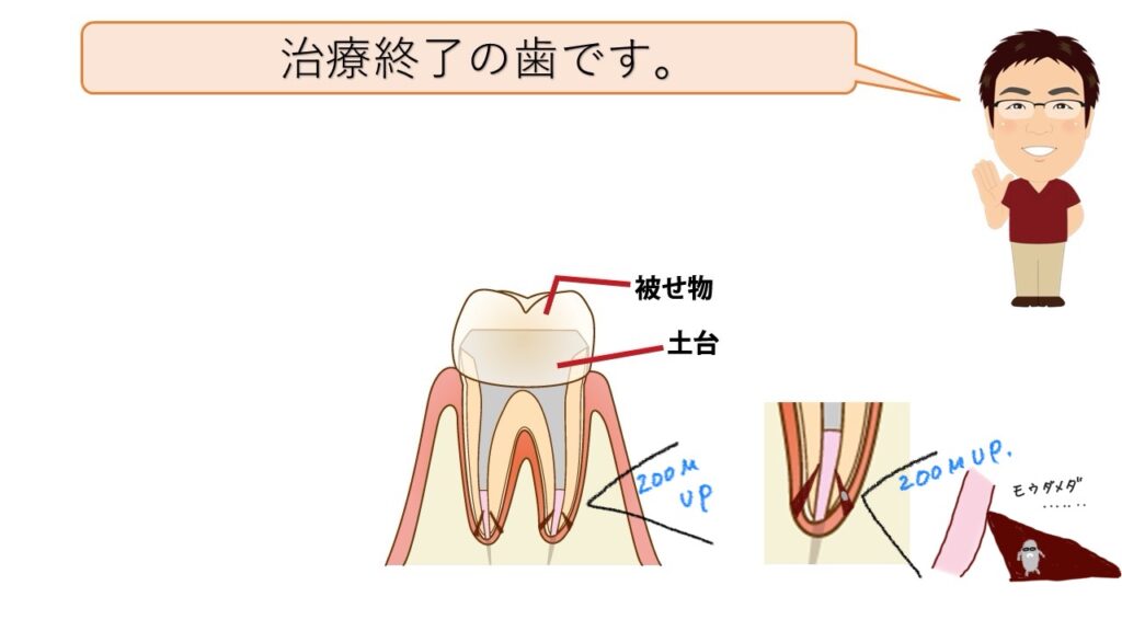 治療終了の歯