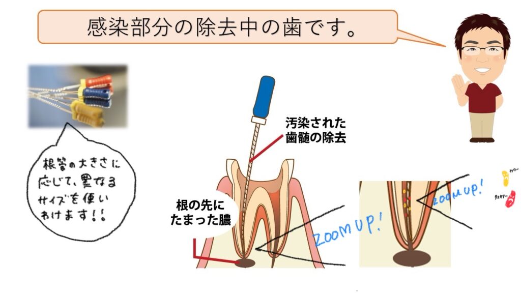 感染部分の除去中の歯