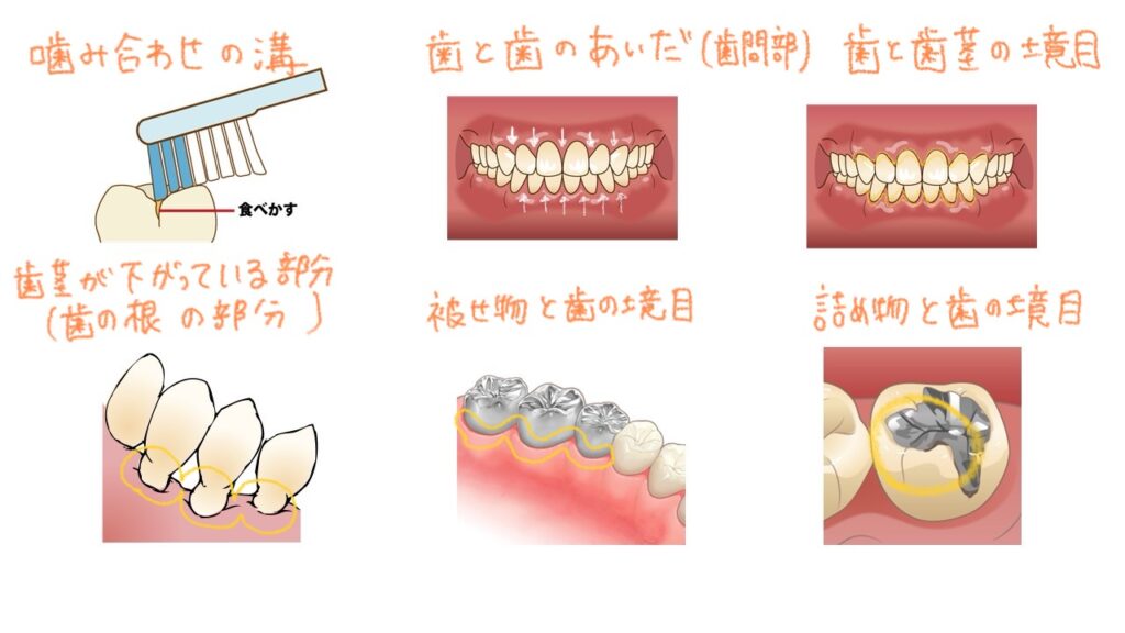 プラークが溜まりやすい場所