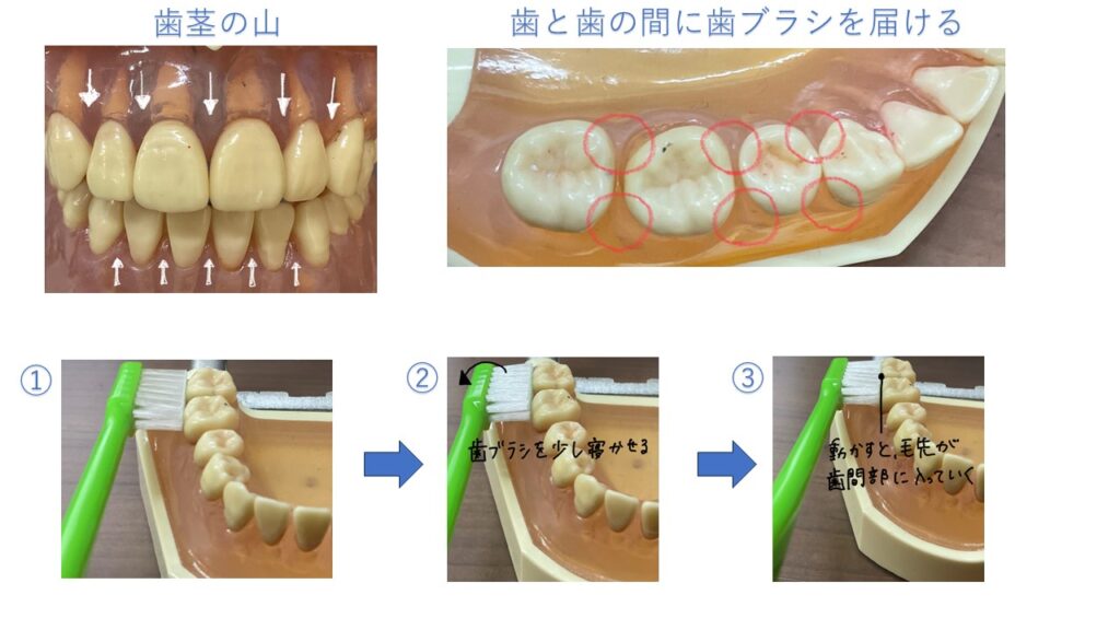 歯ブラシの当て方