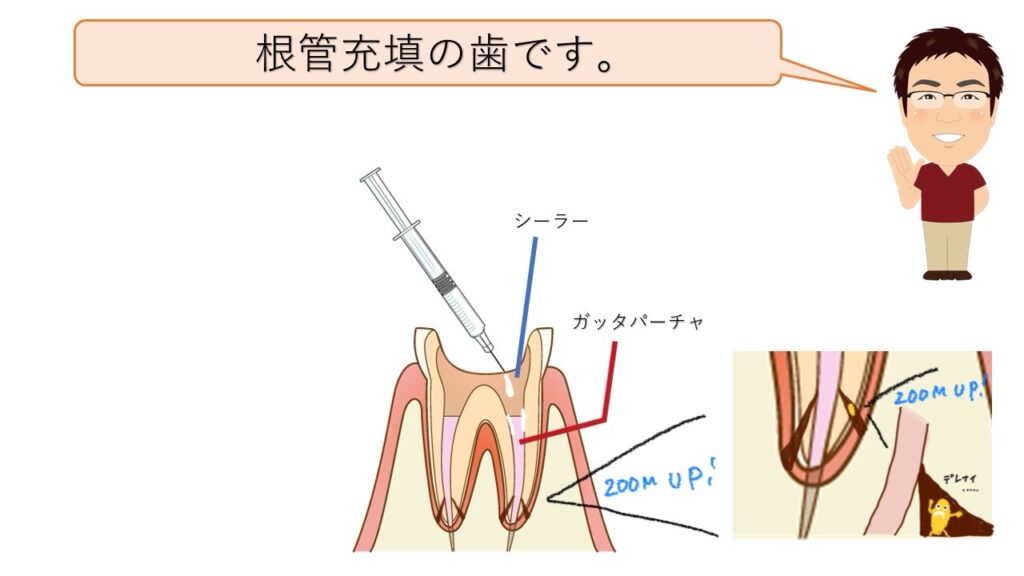 根管充填の歯