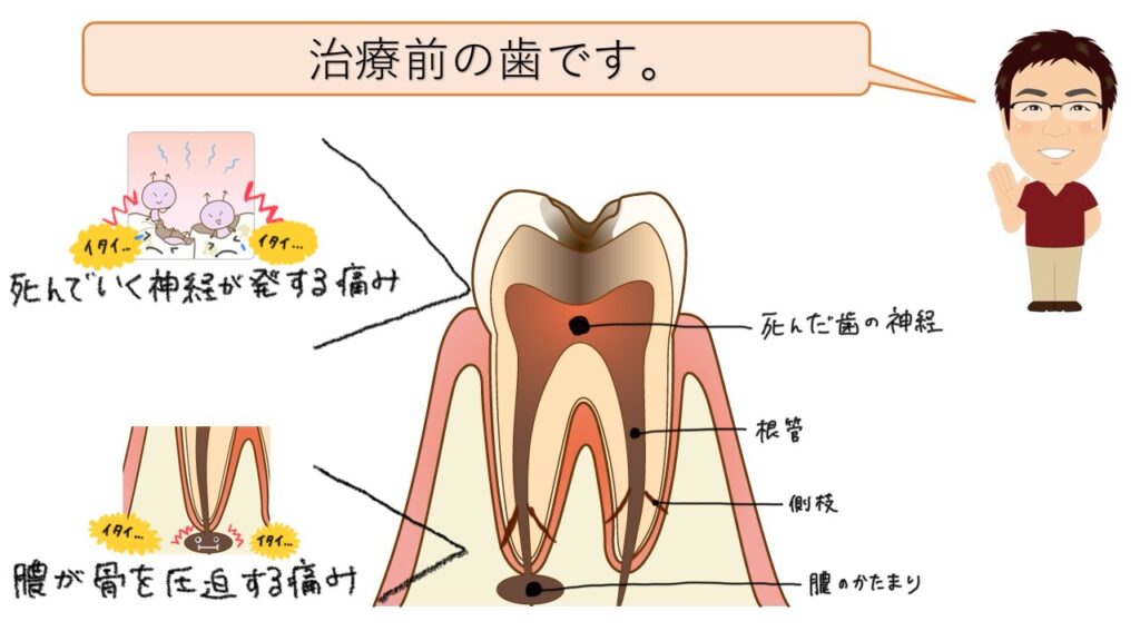 治療前の歯