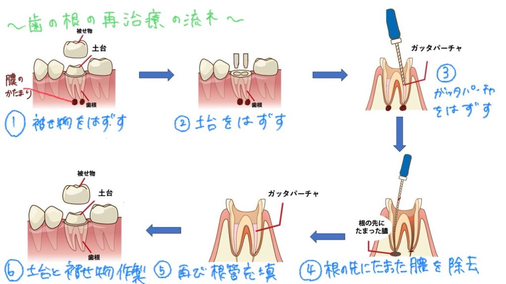 歯の根の再治療の流れ