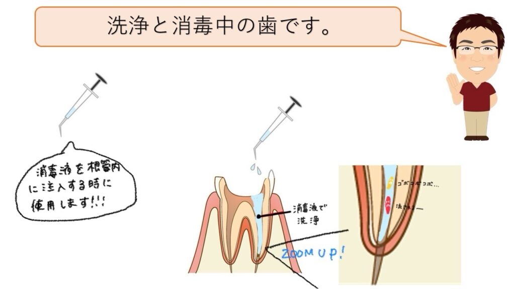 洗浄と消毒中の歯