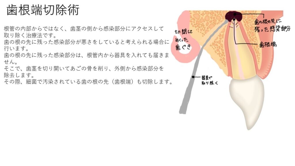 歯根端切除術