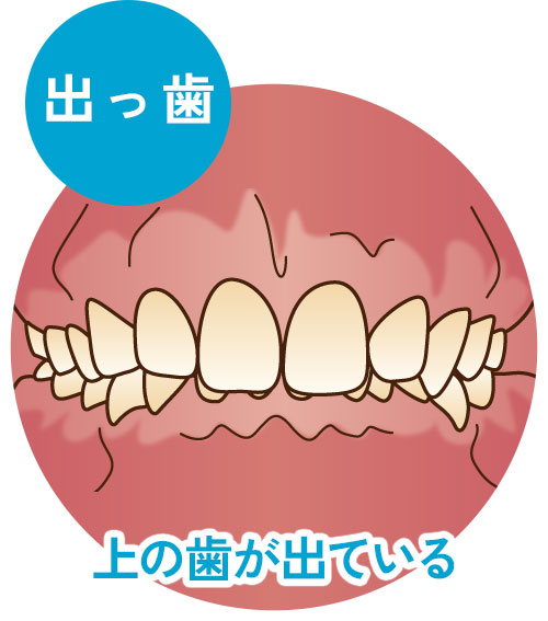 出っ歯