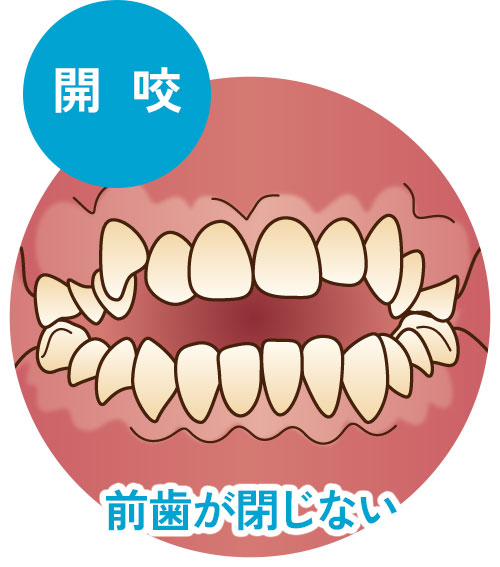 開咬