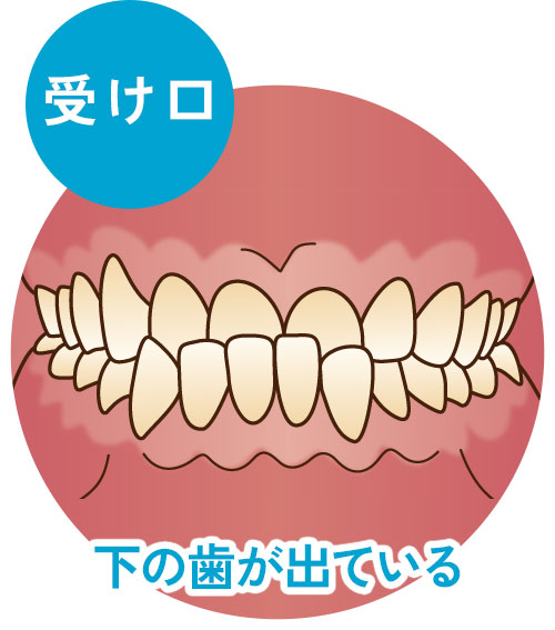 受け口