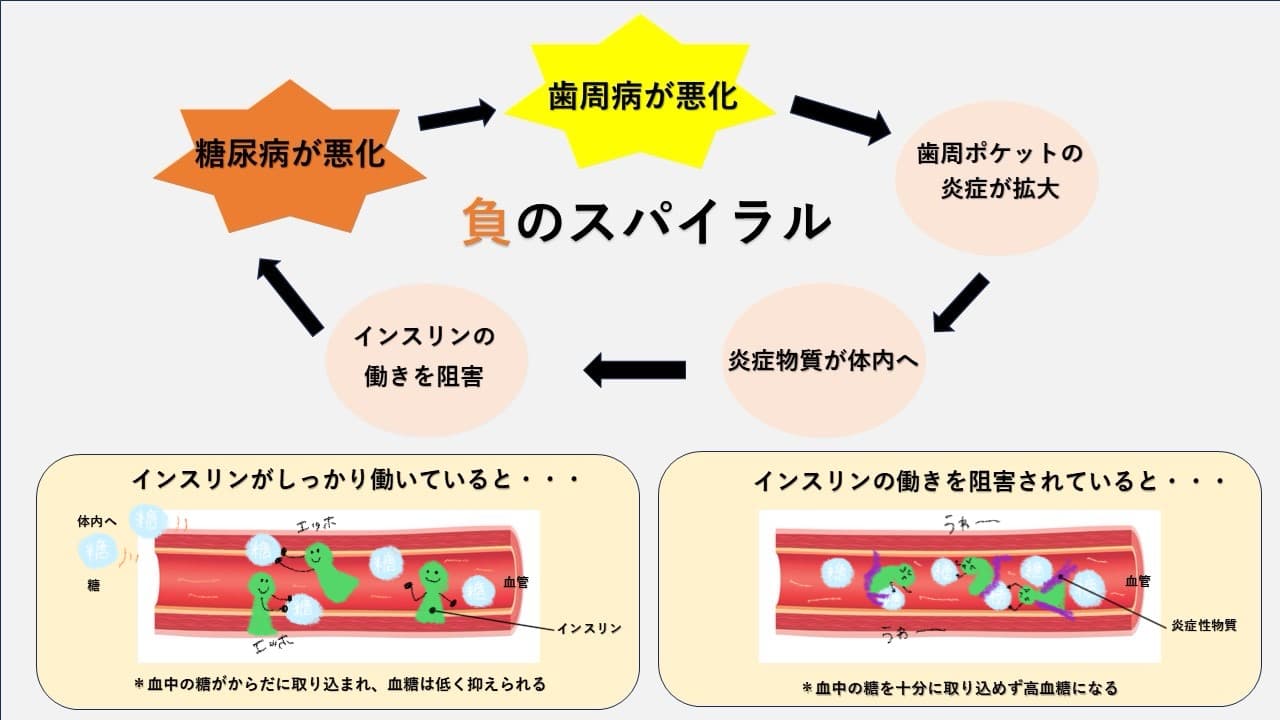 歯周病と糖尿病