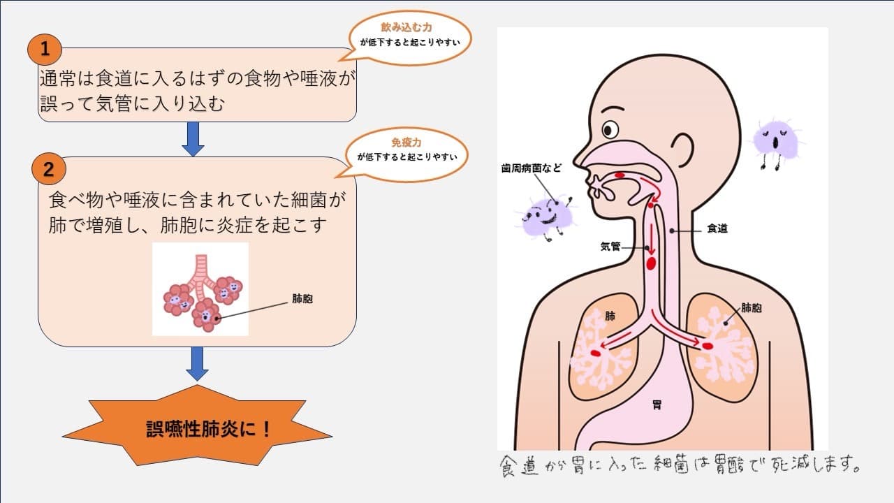 歯周病と誤嚥性肺炎