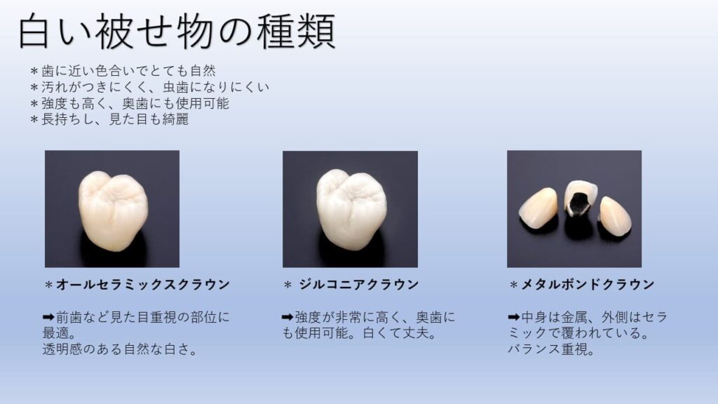 白い被せ物の種類