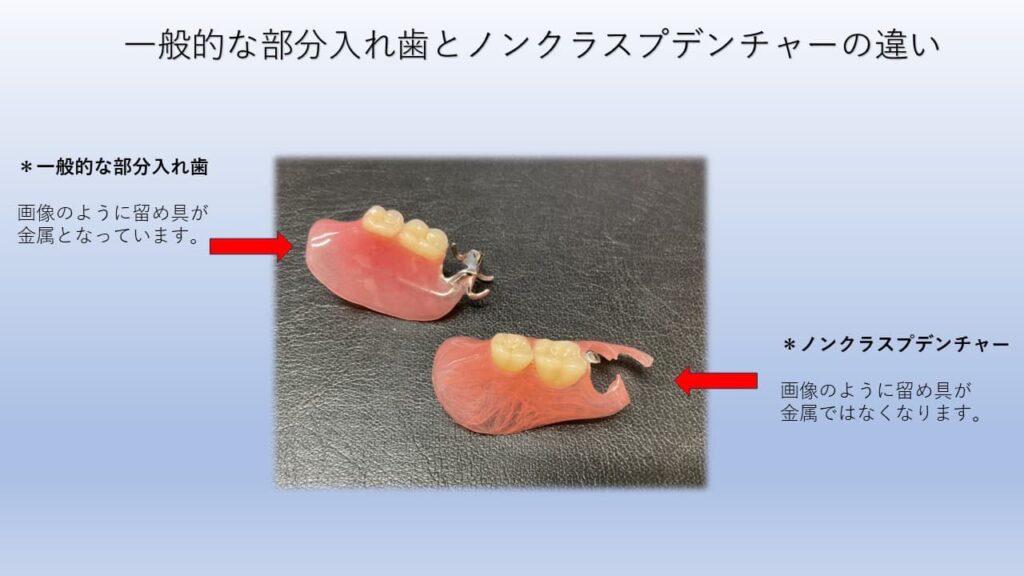 一般的な部分入れ歯とノンクラスプデンチャーの違い