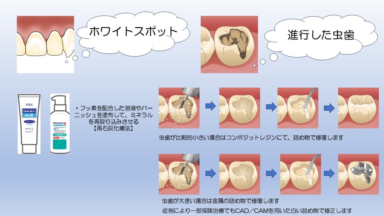 虫歯による変色を白くする方法