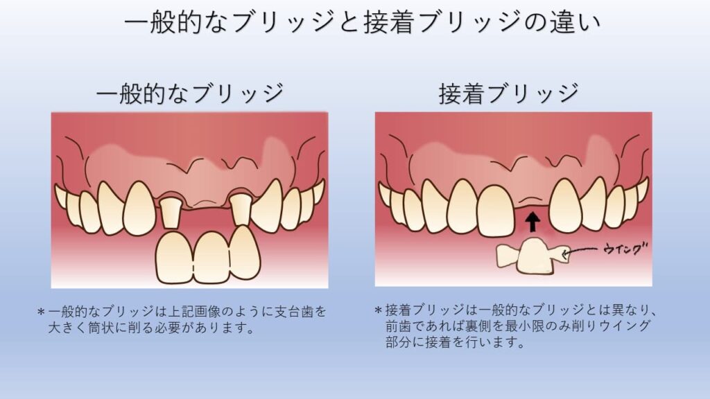 一般的なブリッジと接着ブリッジの違い