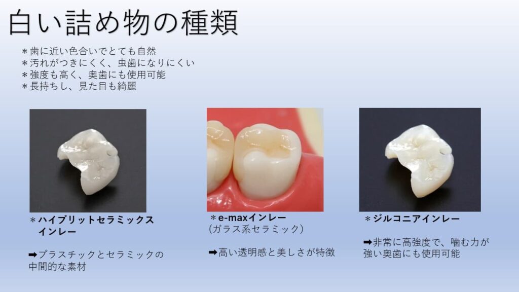 白い詰め物の種類