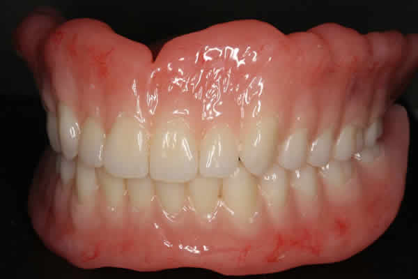 短期集中」フルオーダーメイド義歯（BPSデンチャー・入れ歯）｜しぎの